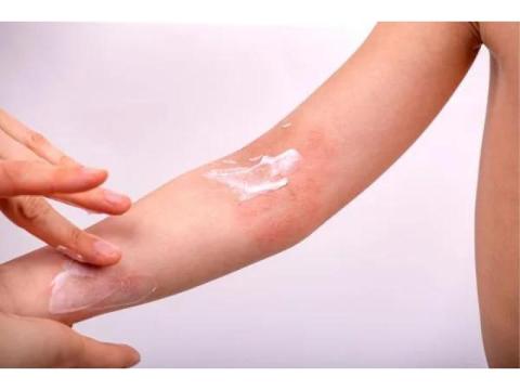 Allergic Dermatitis Treatment – Expert Skin Care Solutions