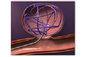 Restore Vascular Health with Expert Coil Embolization Procedure