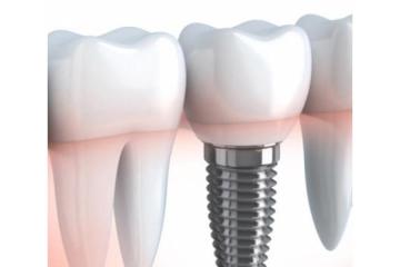 Dental Implant Surgery with Safe and Professional Care