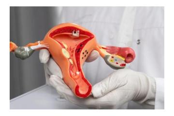 Dr. Manish Singhal Best Cervical Cancer Doctor Delhi