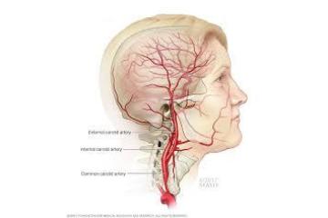 Advanced Carotid Angioplasty with Stent Treatment