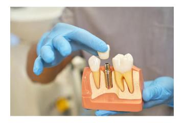 Restore Missing Teeth with Dental Implants