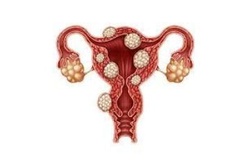 Fibroid Prevention Tips for Better Women’s Health and Long-Term Wellness