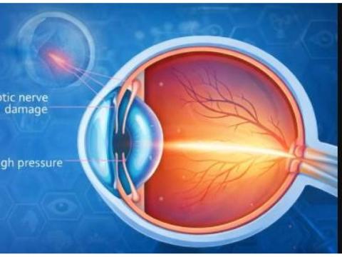 Trusted Choice for the Best Glaucoma Specialist in Delhi for Advanced Eye Care