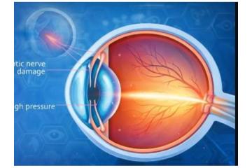 Trusted Choice for the Best Glaucoma Specialist in Delhi for Advanced Eye Care