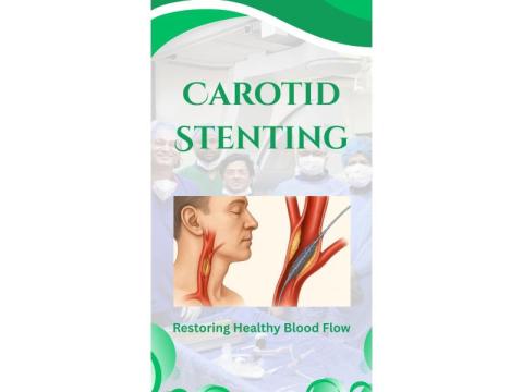  Carotid Stent Treatment for Optimized Blood Circulation and Stroke Prevention
