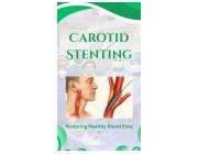  Carotid Stent Treatment for Optimized Blood Circulation and Stroke Prevention
