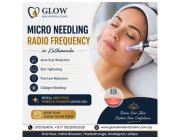 Micro Needling Radio Frequency in Kathmandu for Skin Tightening