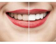 Teeth Whitening in Mount Roskill, Auckland