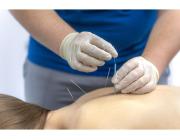 Experience Effective Central London Acupuncture for Natural Pain Relief