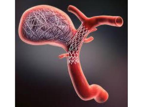 Aneurysm Coiling – Advanced Protection Against Aneurysm Rupture