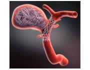 Aneurysm Coiling – Advanced Protection Against Aneurysm Rupture