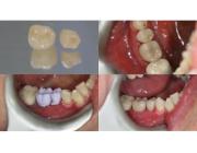 Same Day CEREC Crowns in Marlow for Fast Tooth Restoration
