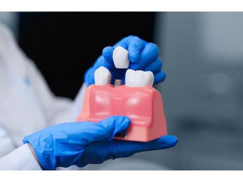 Best Dental Implants Melbourne for a Confident Smile
