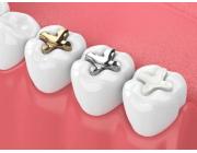 Top Wisdom Teeth Removal Melbourne CBD Dental