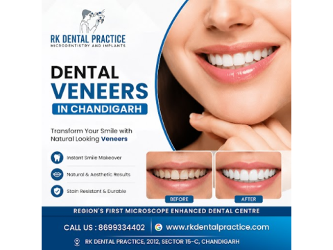 Dental Veneers Near You for a Perfect Smile Transformation