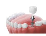 Dental Implants in Mount Roskill, Auckland