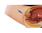 IUI Treatment in Safdarjung Delhi with Comprehensive Fertility Care