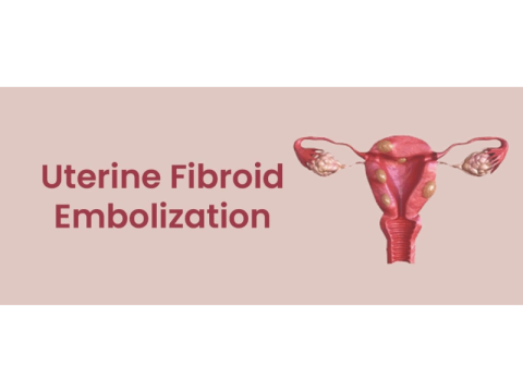 UFE Treatment for Uterine Fibroids | Minimally Invasive Care