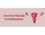 UFE Treatment for Uterine Fibroids | Minimally Invasive Care
