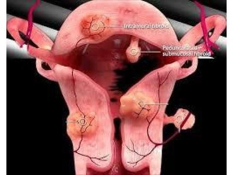 Uterine Fibroid Embolization | Minimally Invasive Fibroid Care - 2/2