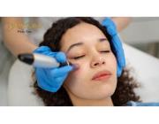 Best Potenza Microneedling Near Me in Riverside