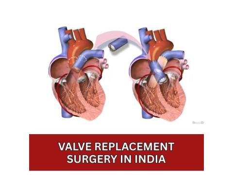 Valve Replacement Surgery in India