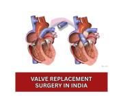 Valve Replacement Surgery in India