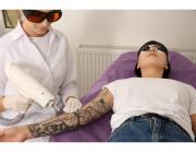 Eyebrow Tattoo Removal St Kilda | Safe & Professional Removal Services