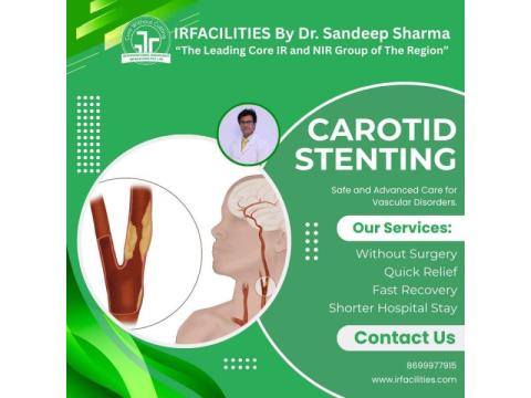 Carotid Stenting | Minimally Invasive Treatment for Stroke Prevention