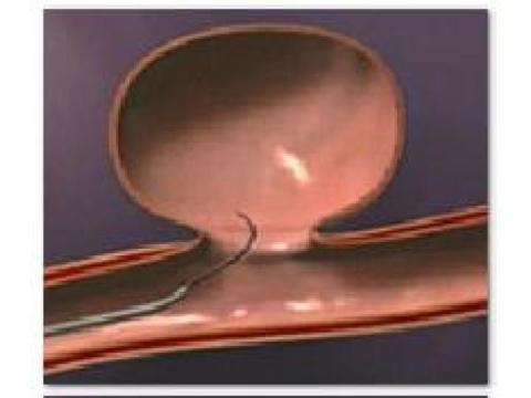 Endovascular Coiling Surgery for Advanced Aneurysm Care | IRFacilities