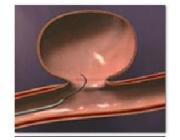 Endovascular Coiling Surgery for Advanced Aneurysm Care | IRFacilities