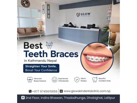Best Teeth Braces in Kathmandu Nepal for Smiles