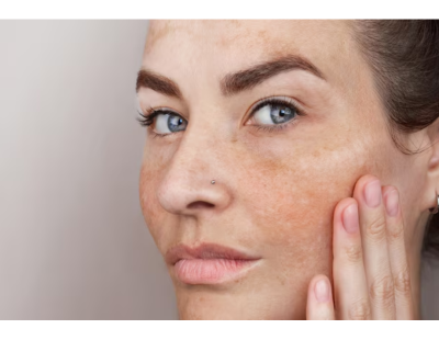 Best Skin Specialist in Gurgaon | Advanced Skin Care | Estique Clinic
