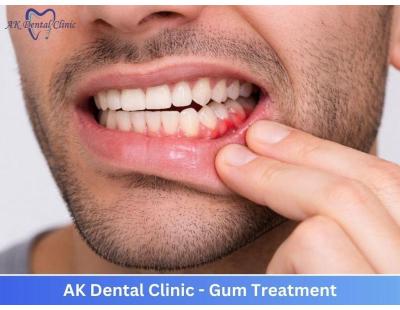 Advanced Laser Gum Treatment in Mumbai | AK Dental Clinic