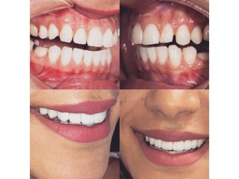 Cosmetic Dentistry in Richmond, TX | Transform Your Smile at Charm Dental - Richmond