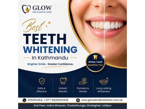 Best Teeth Whitening in Kathmandu for Brighter Smiles