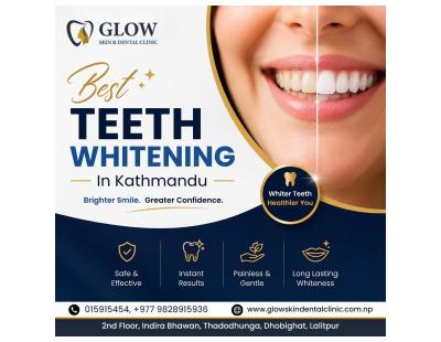 Best Teeth Whitening in Kathmandu for Brighter Smiles