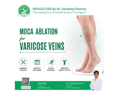 Varicose Veins Specialist | Effective Minimally Invasive Varicose Vein Treatment | IRFacilities