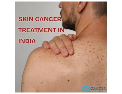 Skin Cancer Treatment in India