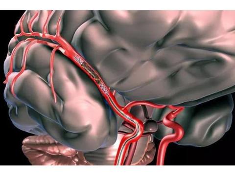 Stroke Health Center Udaipur with Advanced Neurology Care