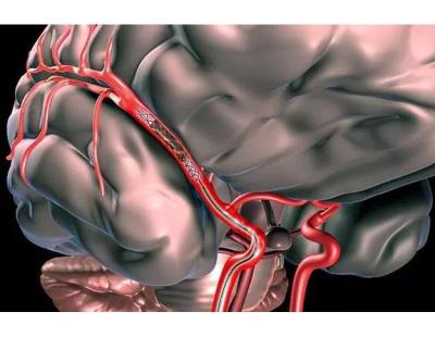Stroke Health Center Udaipur with Advanced Neurology Care