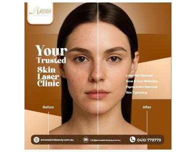 How Laser Technology Is Transforming Skin Care?