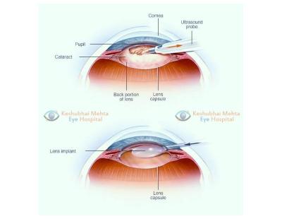 Cataract Operation Rajkot for Clearer Vision and Better Eye Health