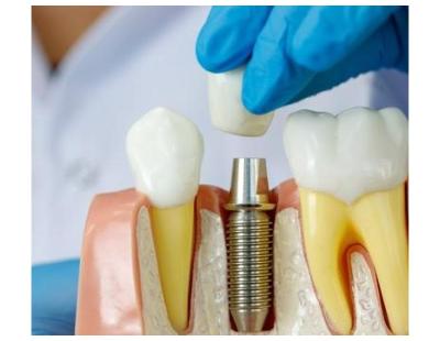 Tooth Implant Process Explained for Better Oral Health