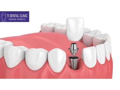 Discovering Dental Implants in Malaysia: What You Need to Know About Costs