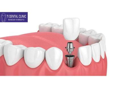 Discovering Dental Implants in Malaysia: What You Need to Know About Costs