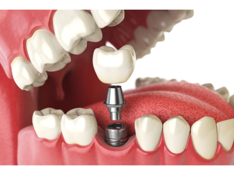 Dental Implants in Chennai: A Comprehensive Guide