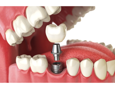 Dental Implants in Chennai: A Comprehensive Guide