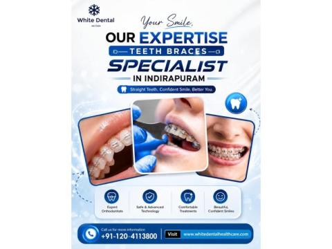 Teeth Braces Specialist in Indirapuram for Perfect Smile Alignment